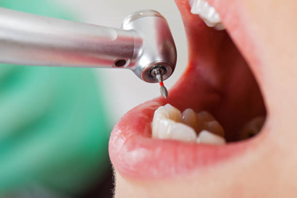 Best Lost Filling or Crown Replacement in Tamalpais Homestead Valley, CA